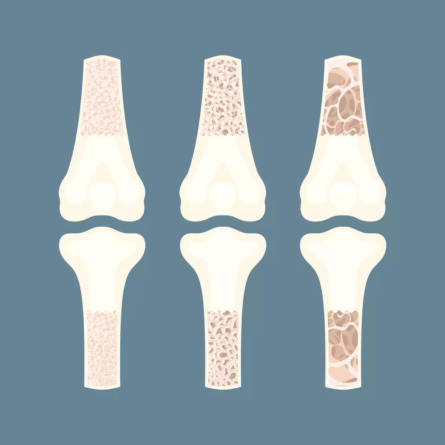 Bone density and skeleton size is impacted by genetics (Getty Stock Images)