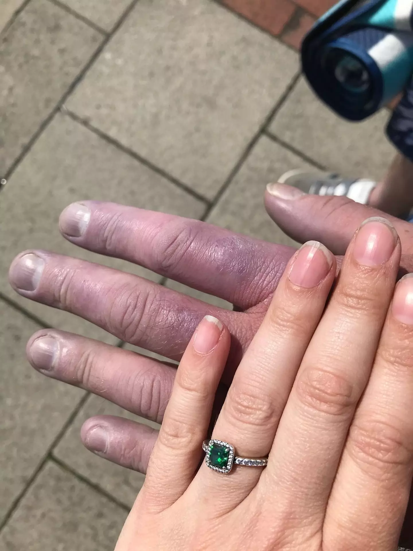 Scott has opened up about his symptoms (PA Real Life)