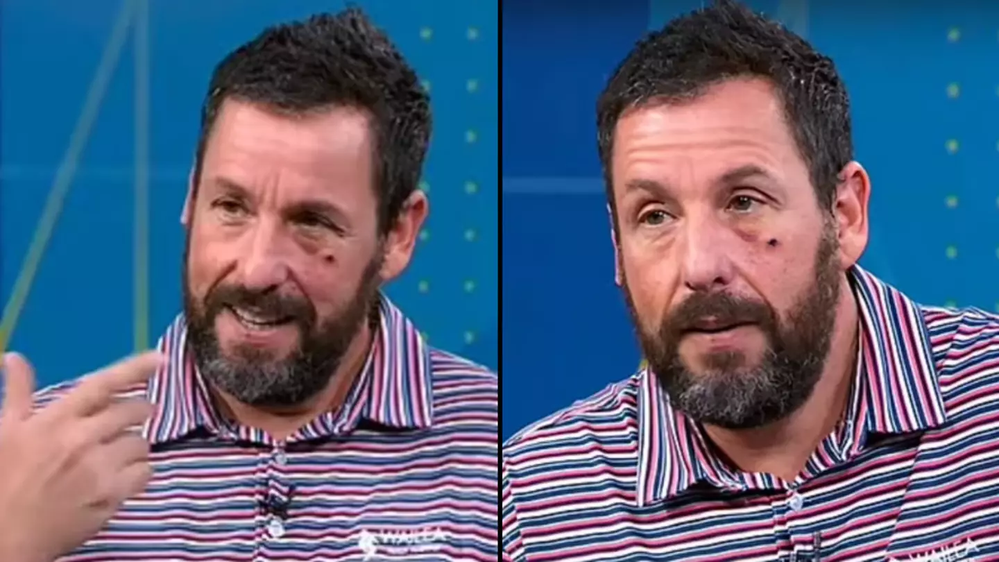 Adam Sandler Forced To Explain After Appearing On TV With Black Eye