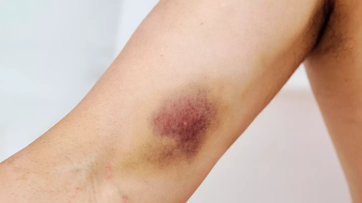 Reason behind 'red spot rash' that can appear anywhere on your body that you might not even notice