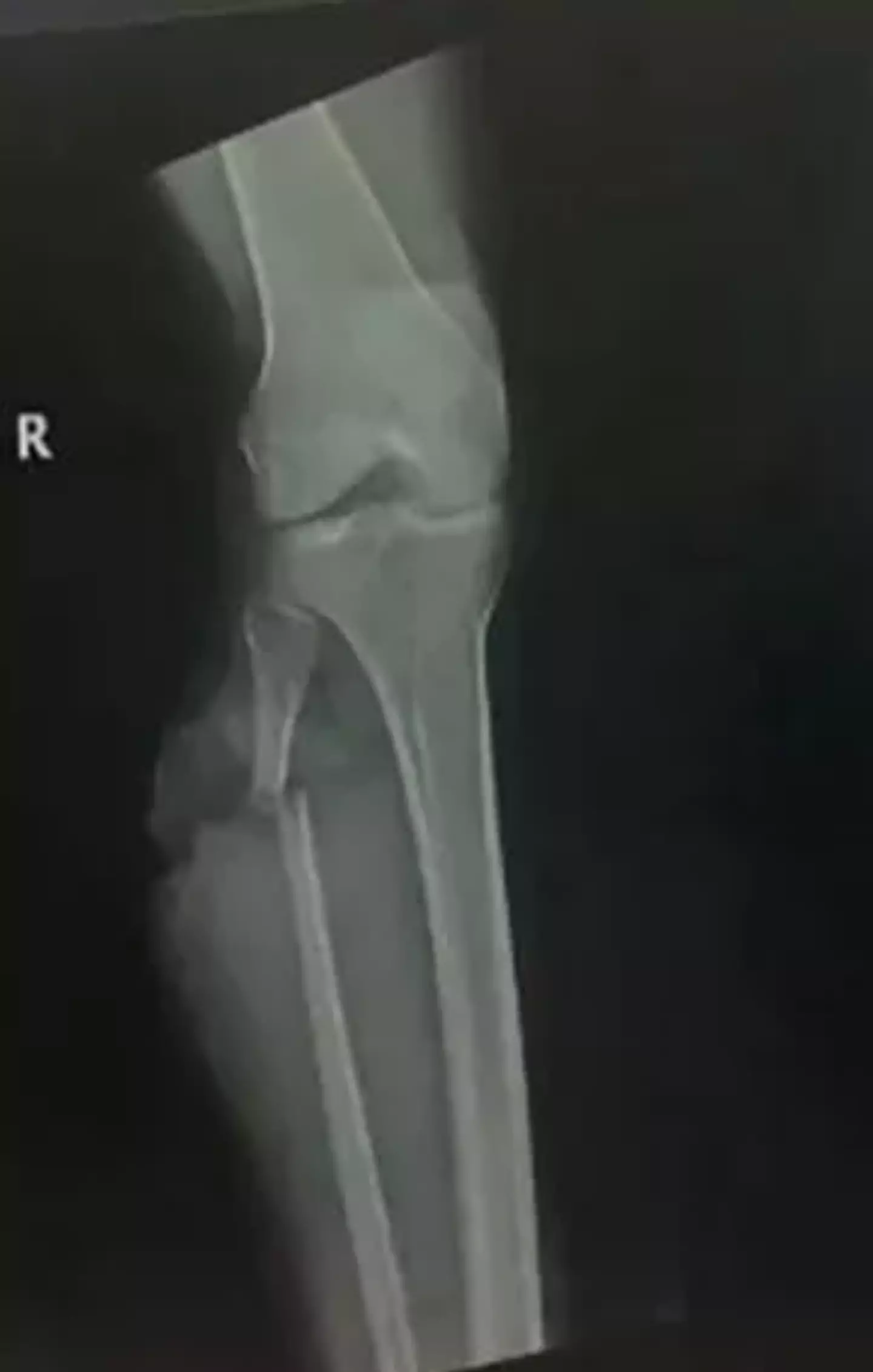 Her leg was seriously injured. (Spectrum News/Rachel Thompson)