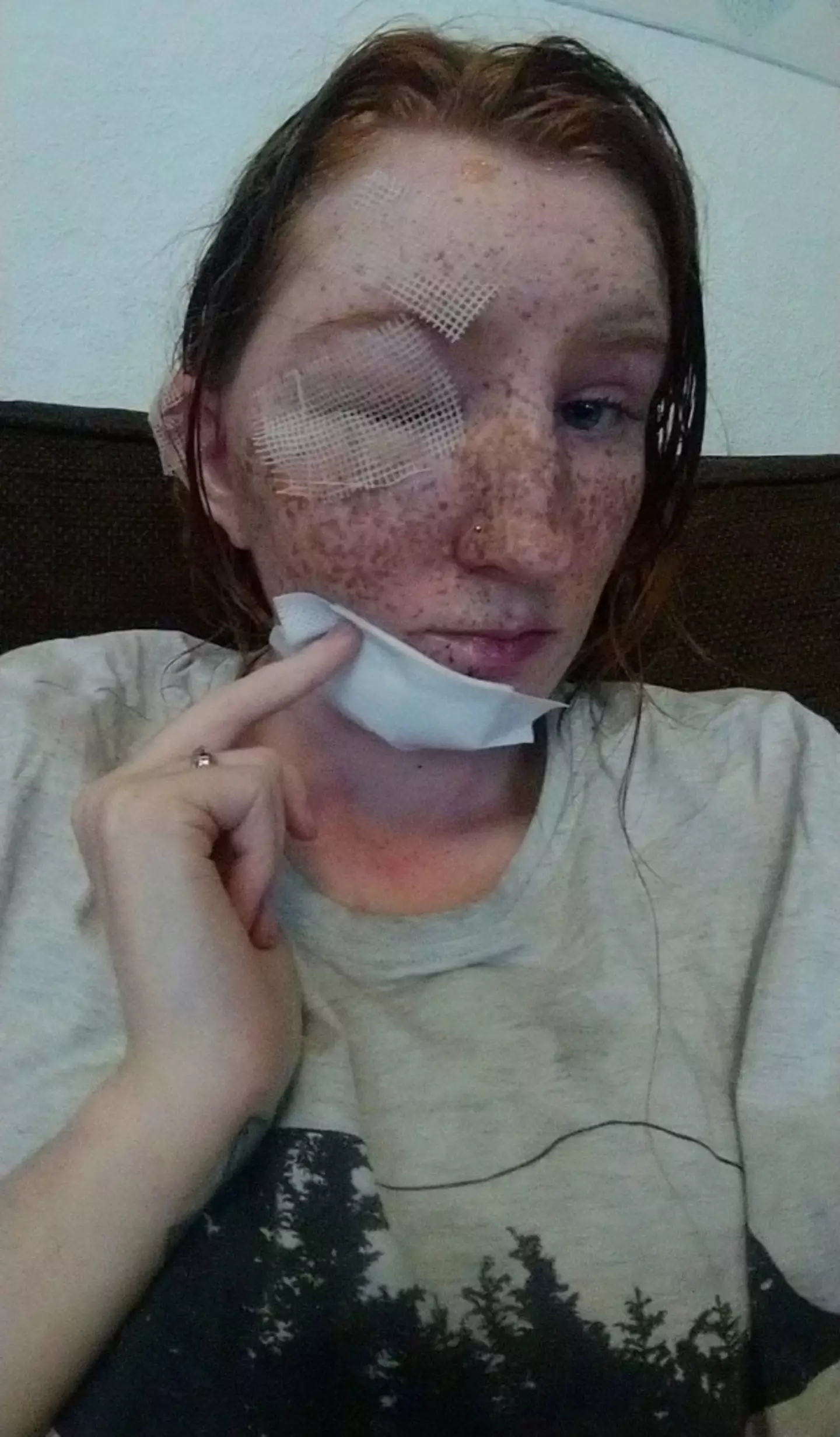 She suffered 'painful injuries and was treated in a specialist burns unit.