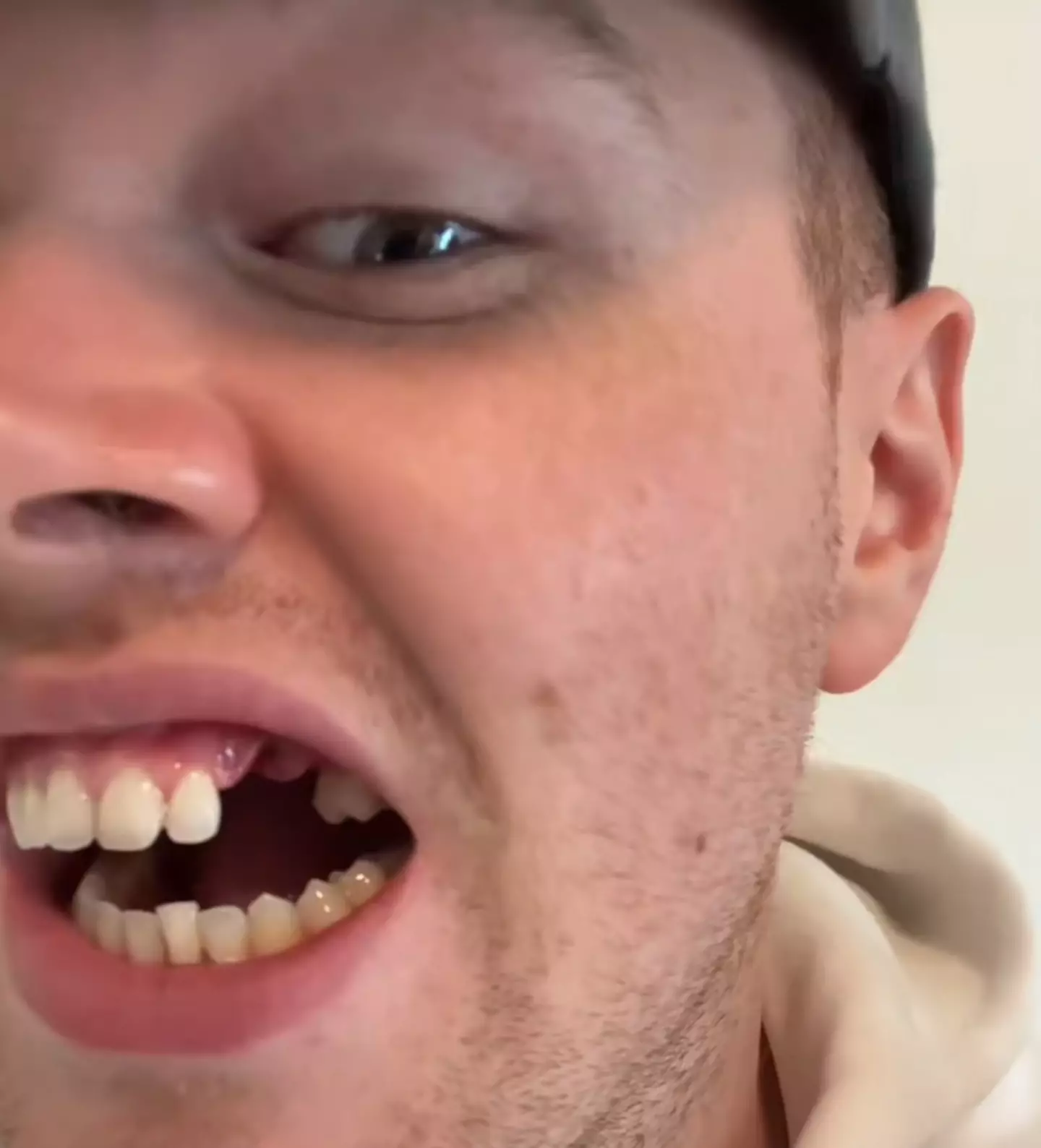 Christopher Scott says he lost his tooth as a result of using white Snus.