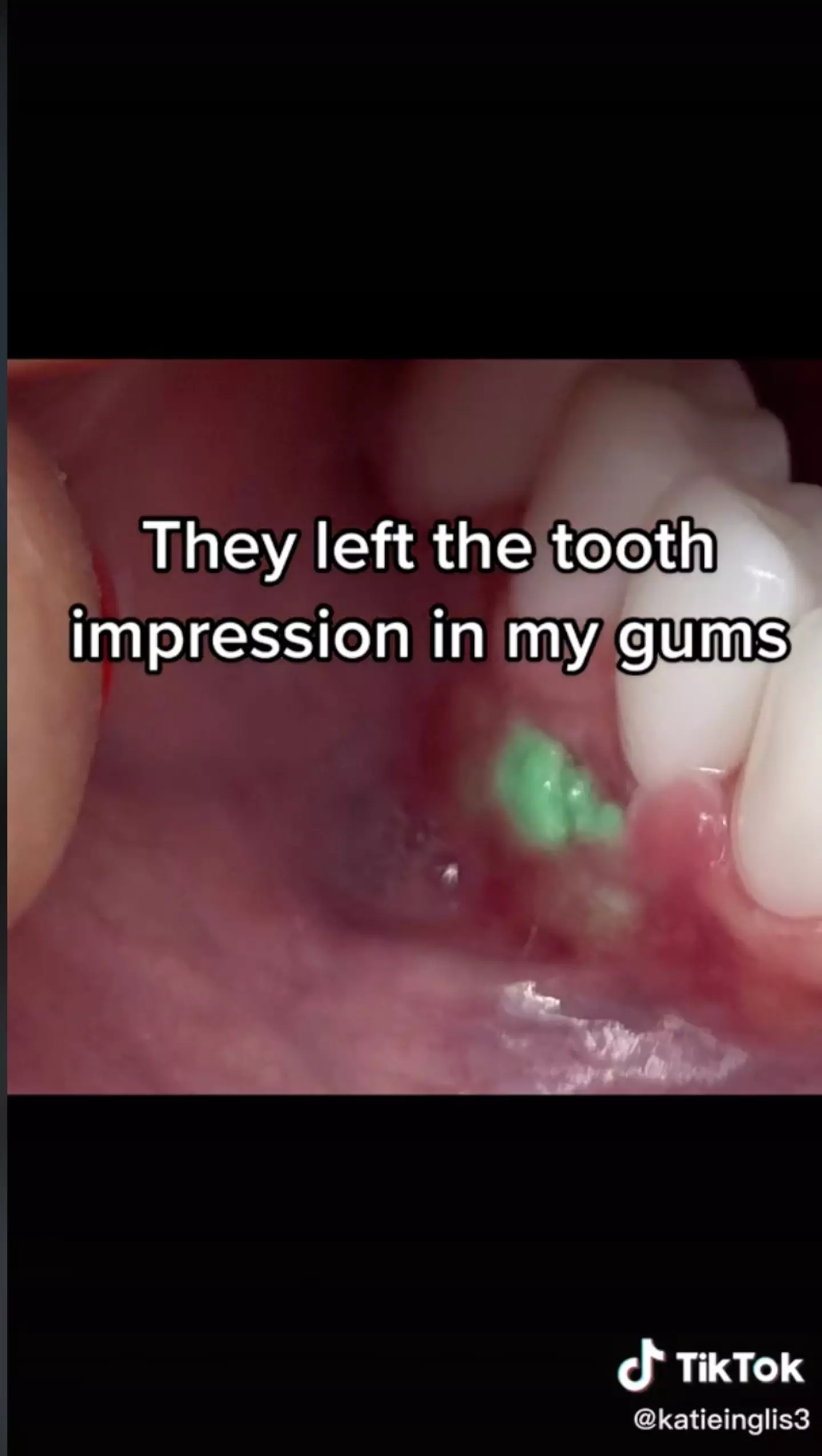 Her gums were visibly left filled with green putty.