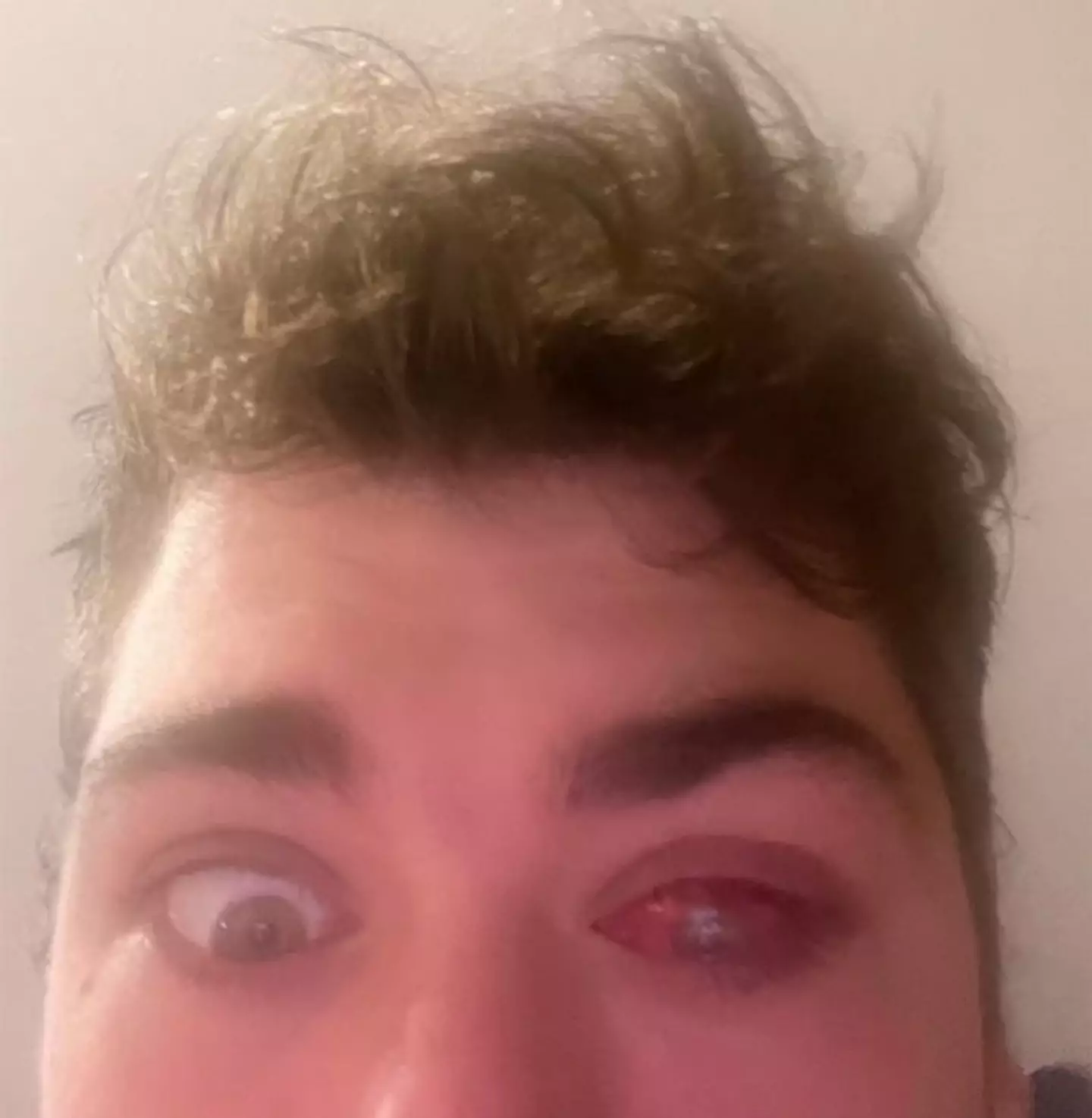 The parasite caused serious damage to his eye.