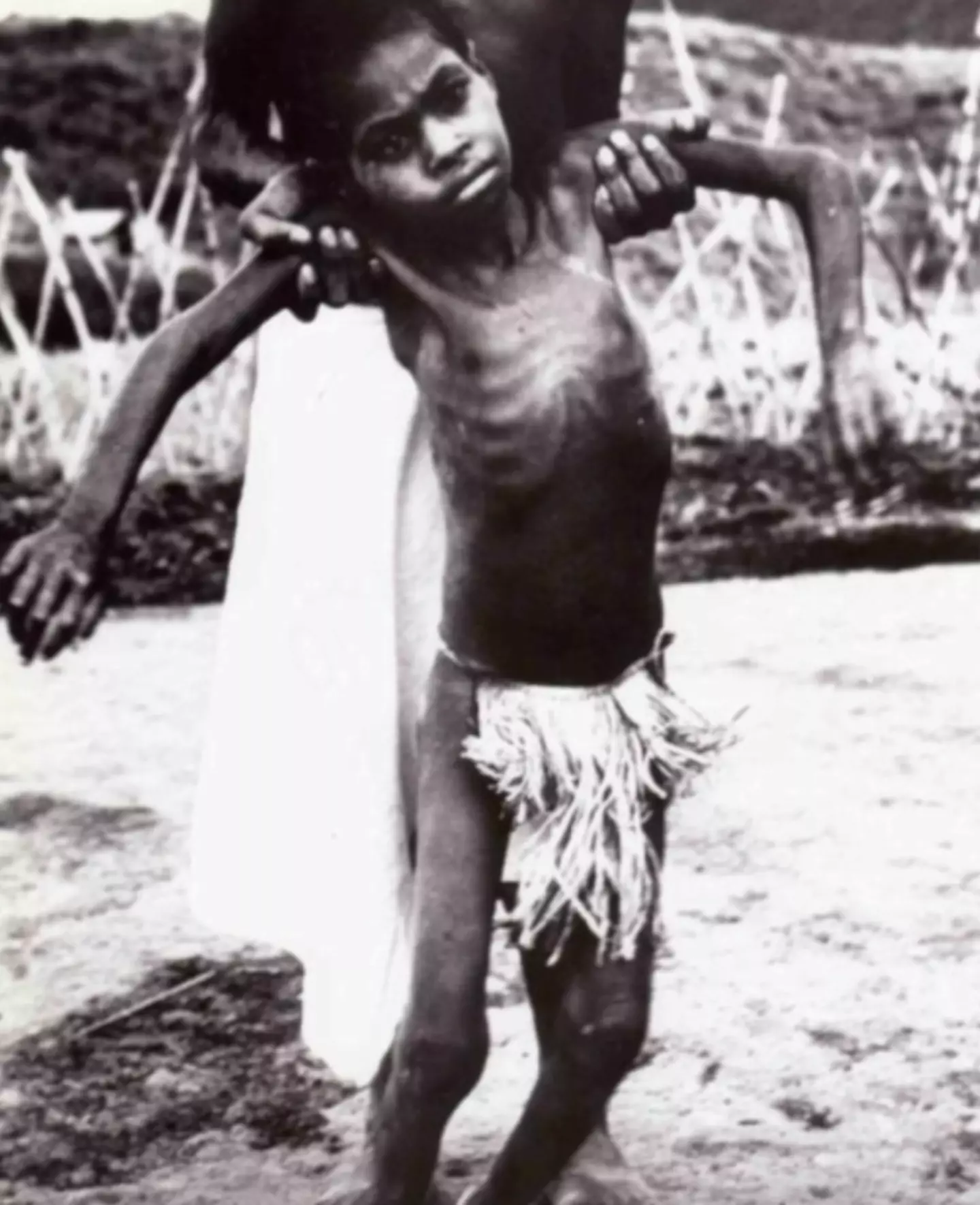 A young child impacted by kuru.