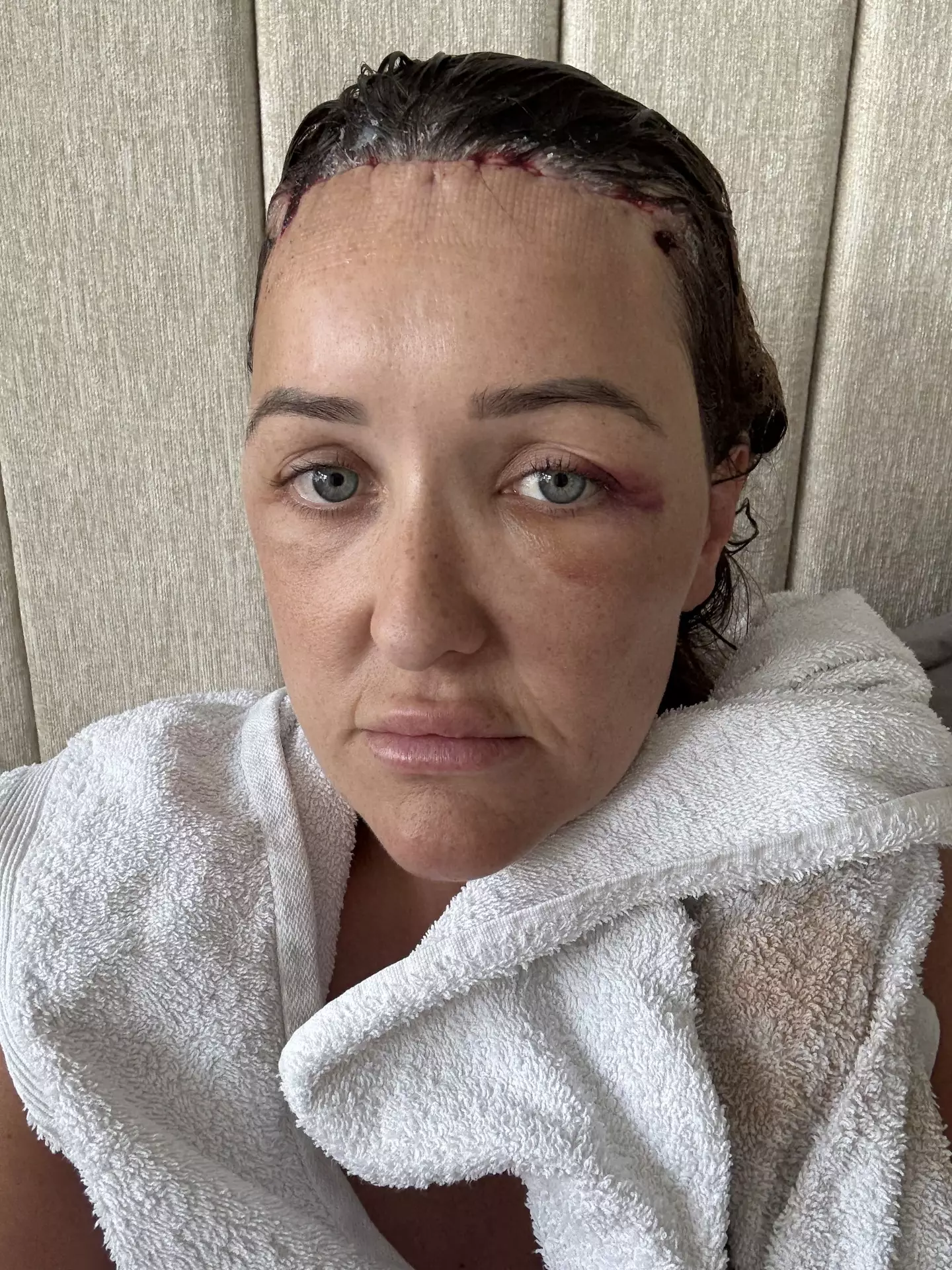 Essex mum Chloe Walker decided to get forehead reduction surgery after being 'self-conscious all my life' (Kennedy News and Media)