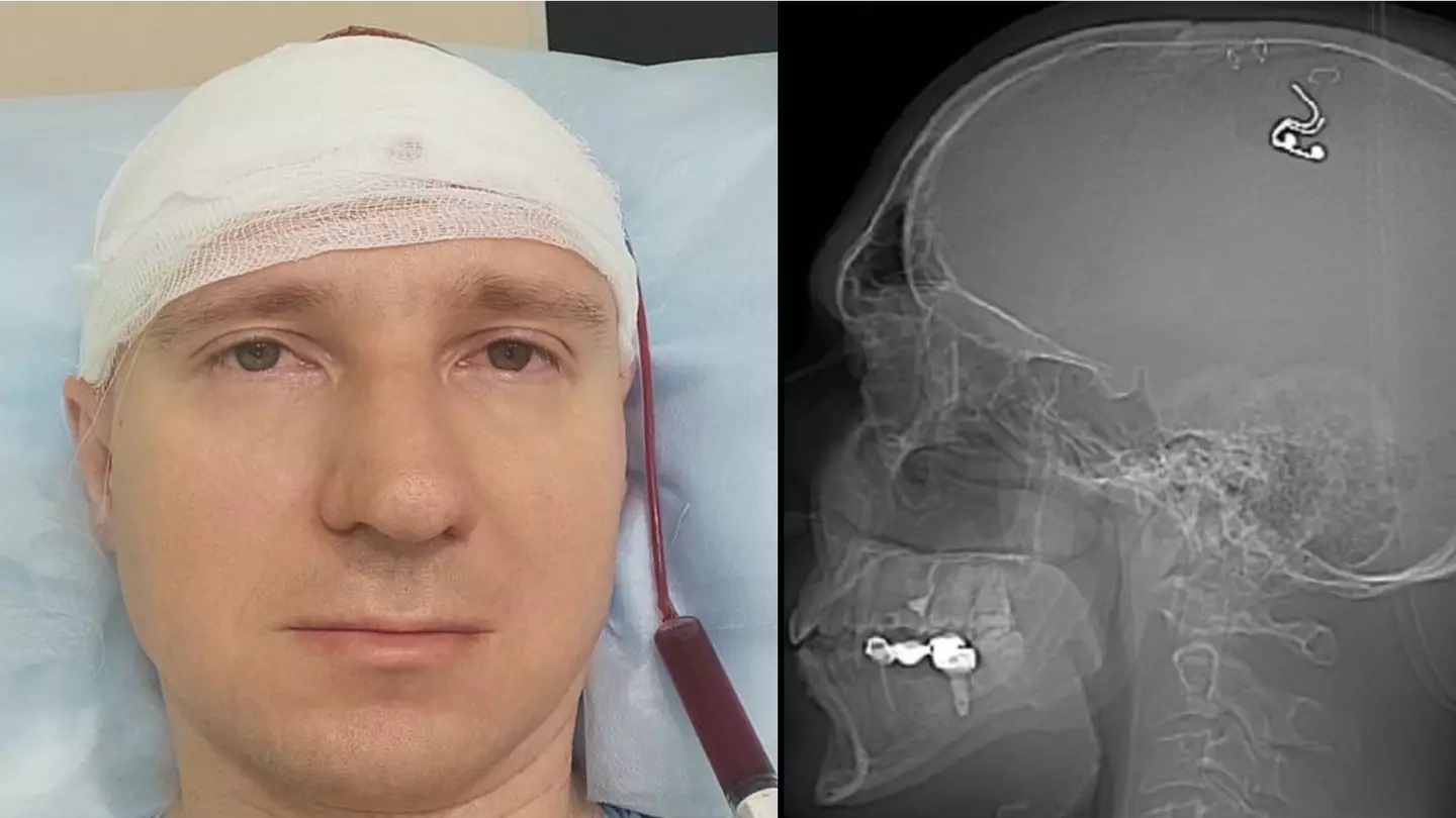 Researcher claims to have implanted chip into his brain which he hopes can control his dreams