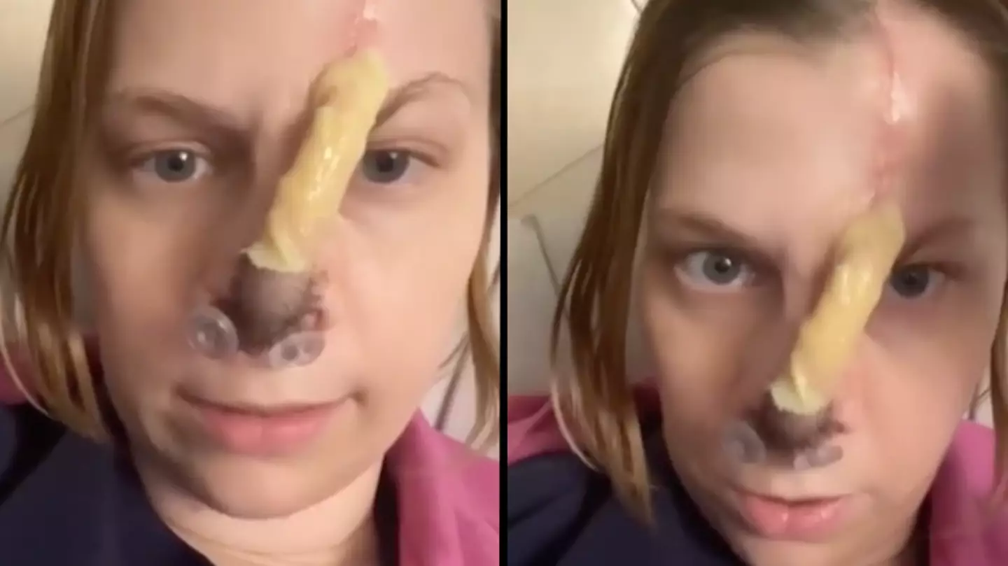 Woman has to get nose reconstructive surgery after 'doing too much cocaine'