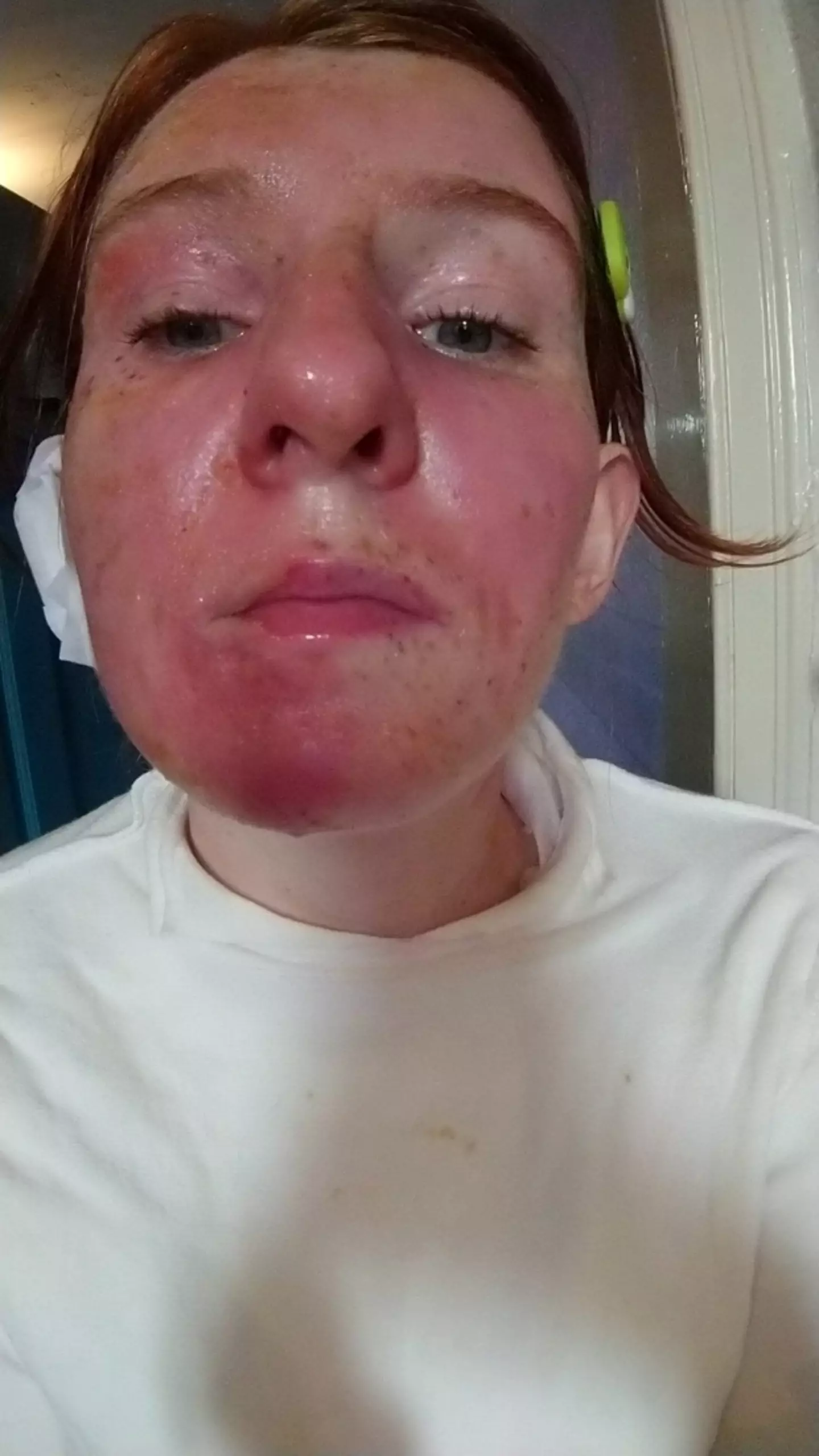 Charlotte's freckles fell off following the incident.