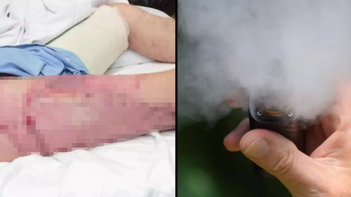 Man issues warning to kids after he was left with serious burns when his vape exploded in his pocket