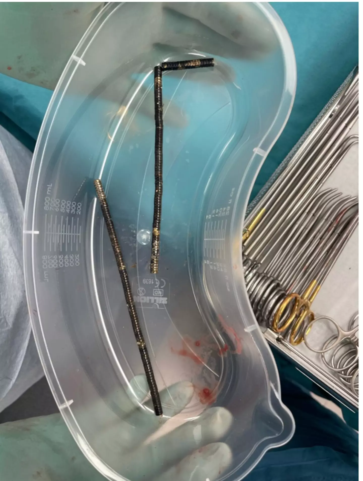 Medics removed somewhere between 80 and 100 of the high-powered magnets from the lad (New Zealand Medical Journal)