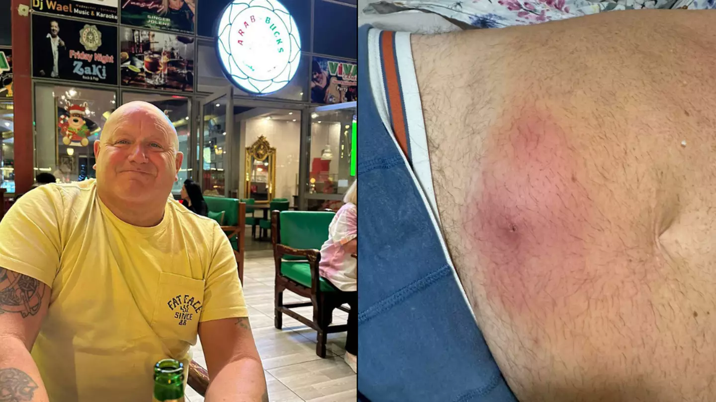 British man issues warning after spider 'bit him in bed' and left him with a deadly flesh-eating disease