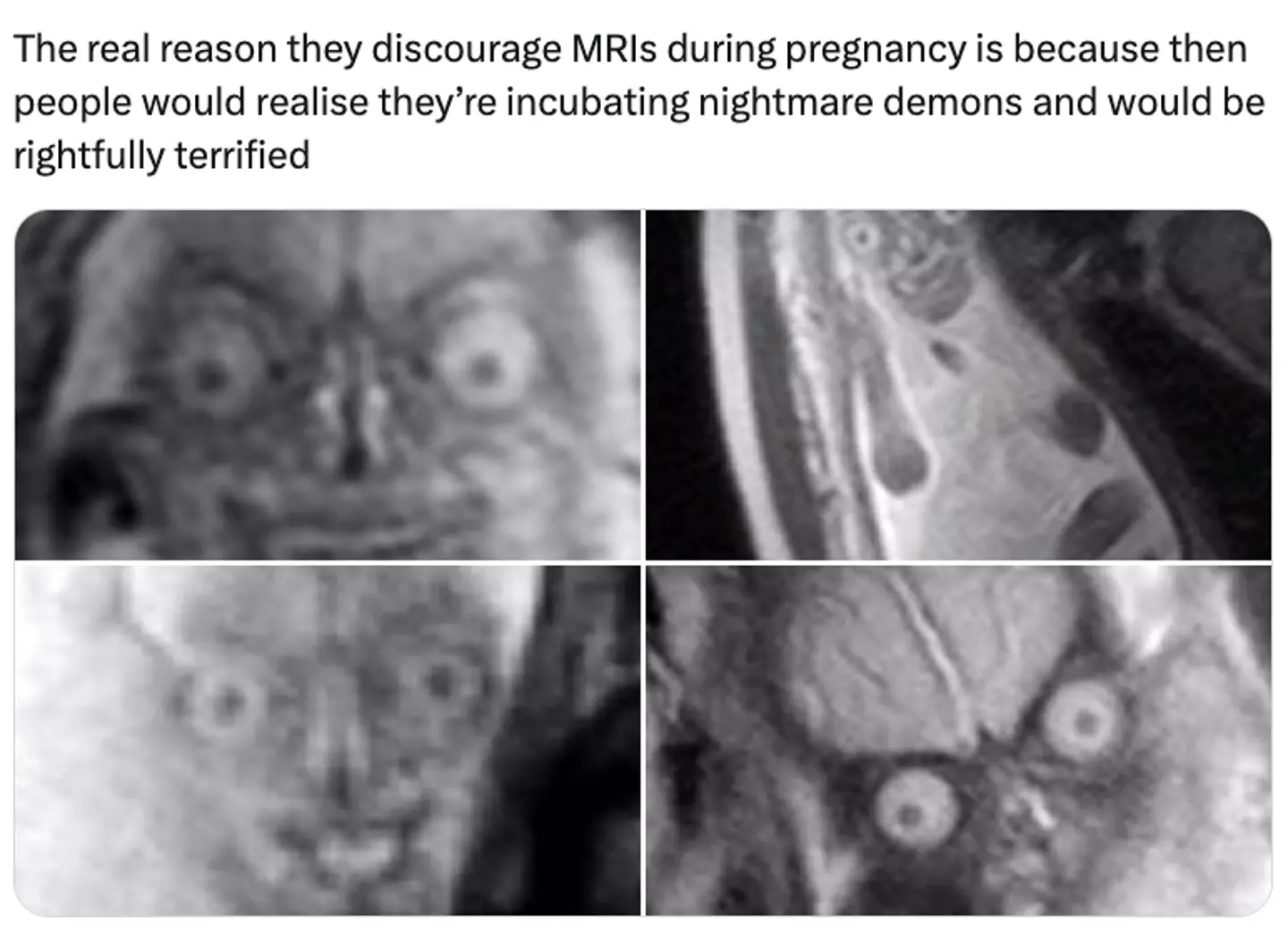 Yep this is how unborn babies look in MRI scans.