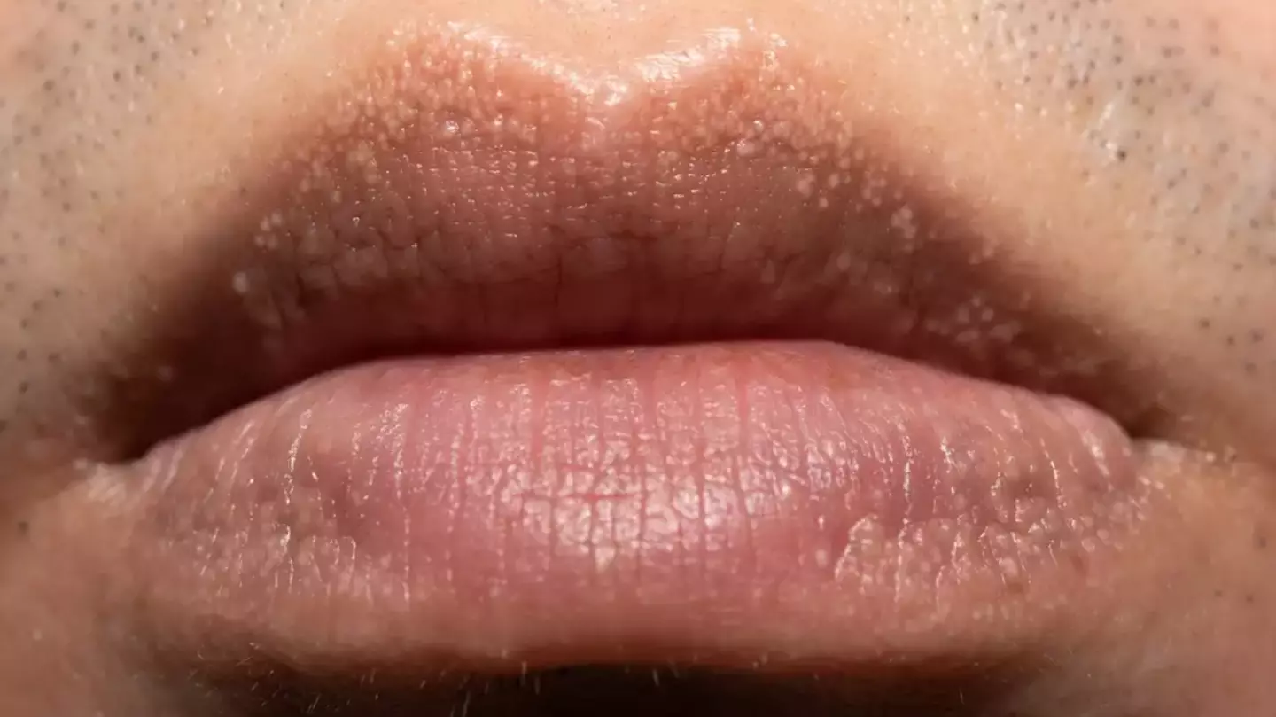 People commonly misidentify strange white bumps you can find on your body and private parts