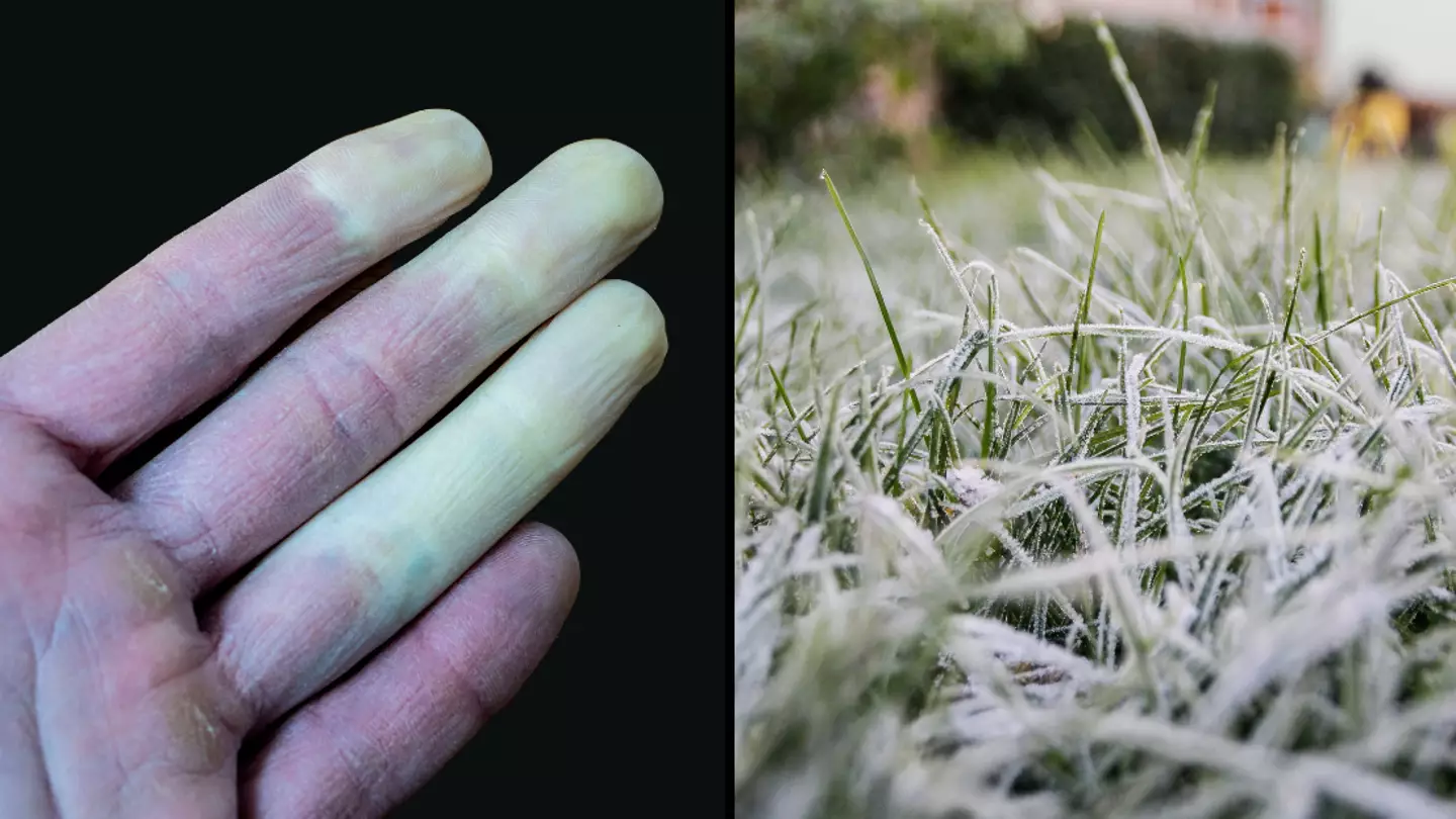Common disease could be why your fingers turn a different colour in cold winter months