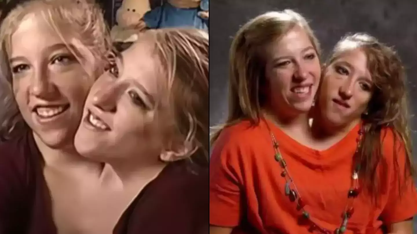 Conjoined twins Abby and Brittany Hensel confirm how their bodies are really connected