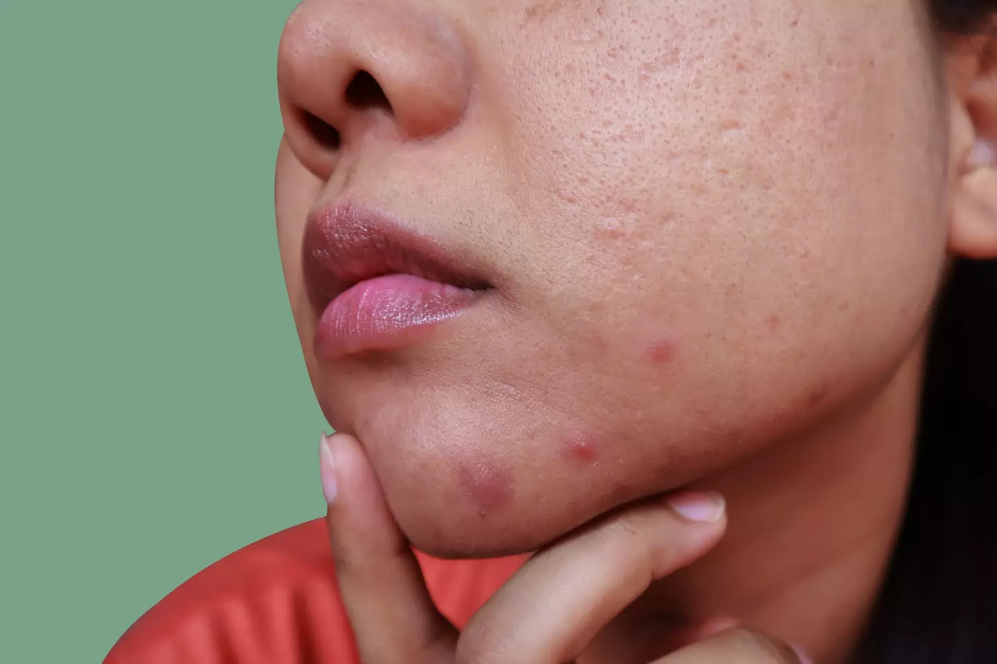 But you really shouldn't 'mess around' with cystic acne, according to Dr Ellis (Getty Stock Image)