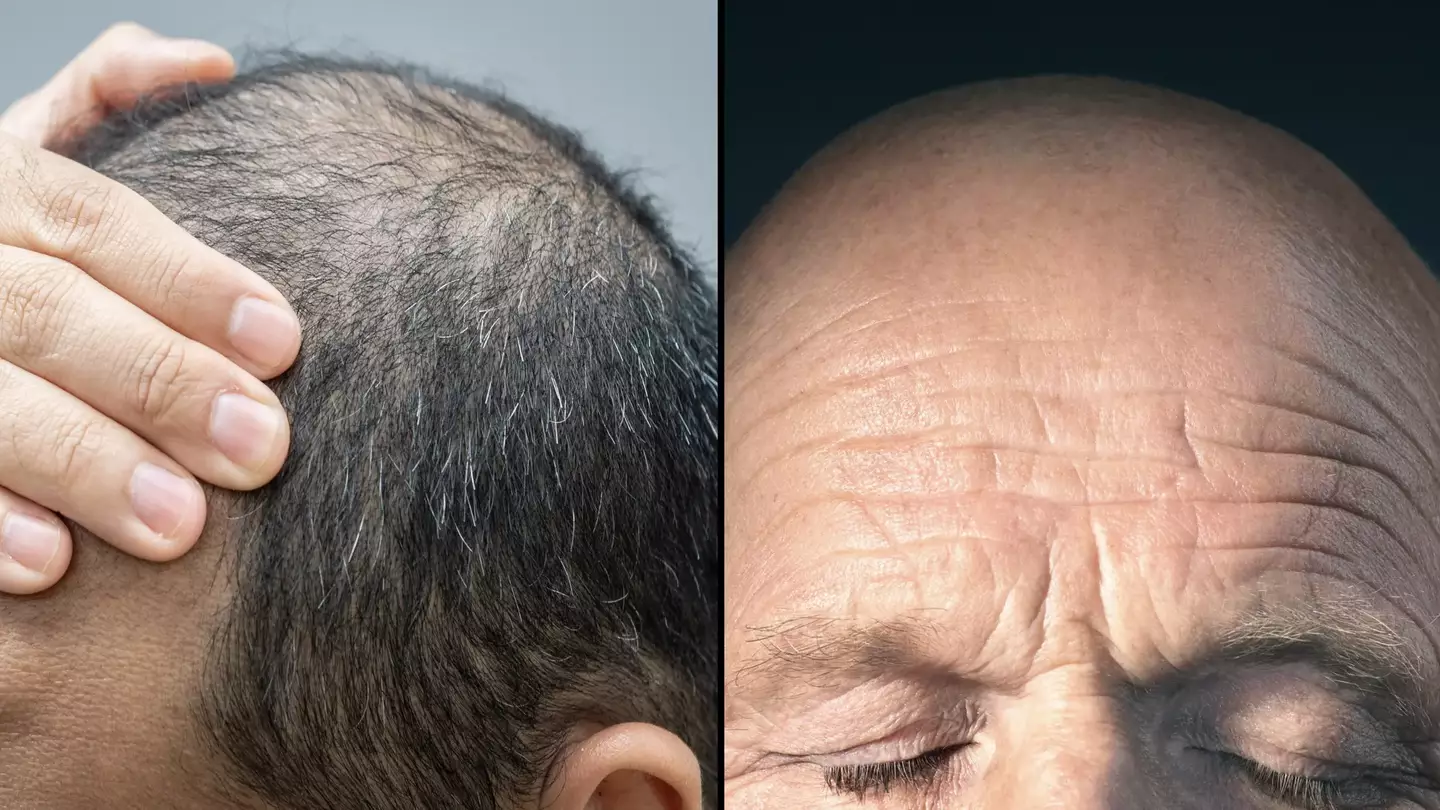 Experts reveal common lifestyle factor that could be making you bald