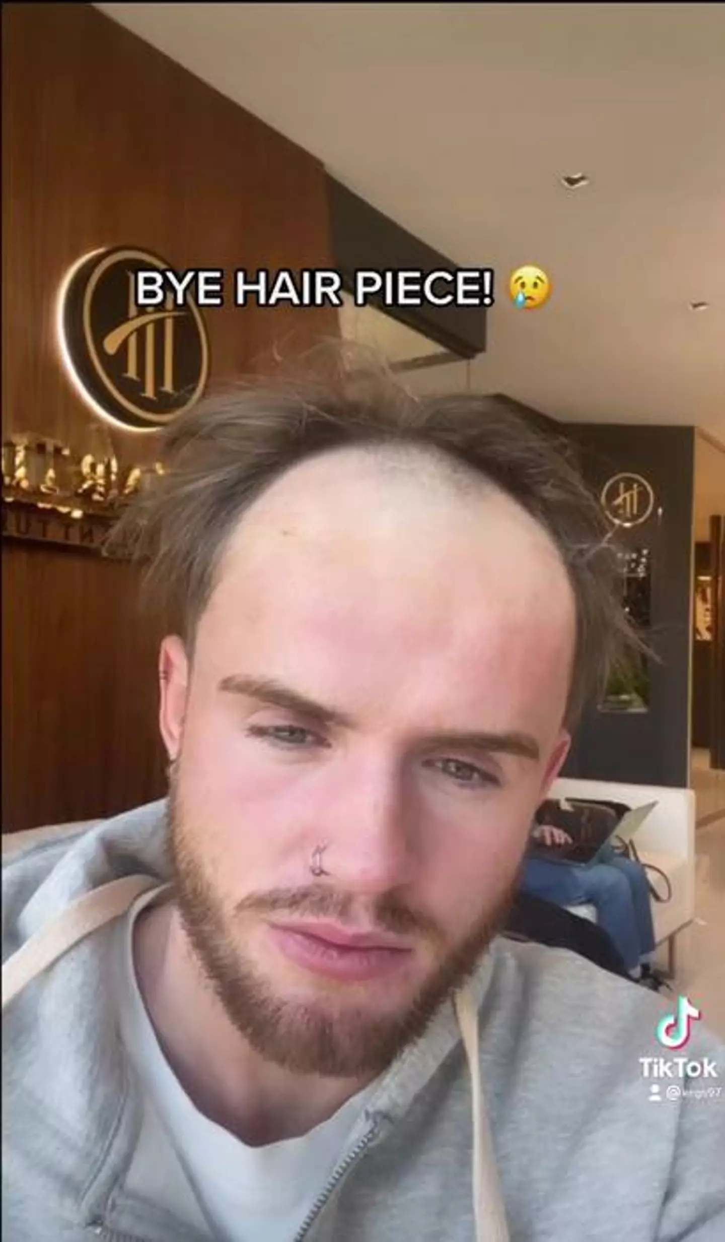 Kegs shed his hairpiece for a more permanent hair transplant.