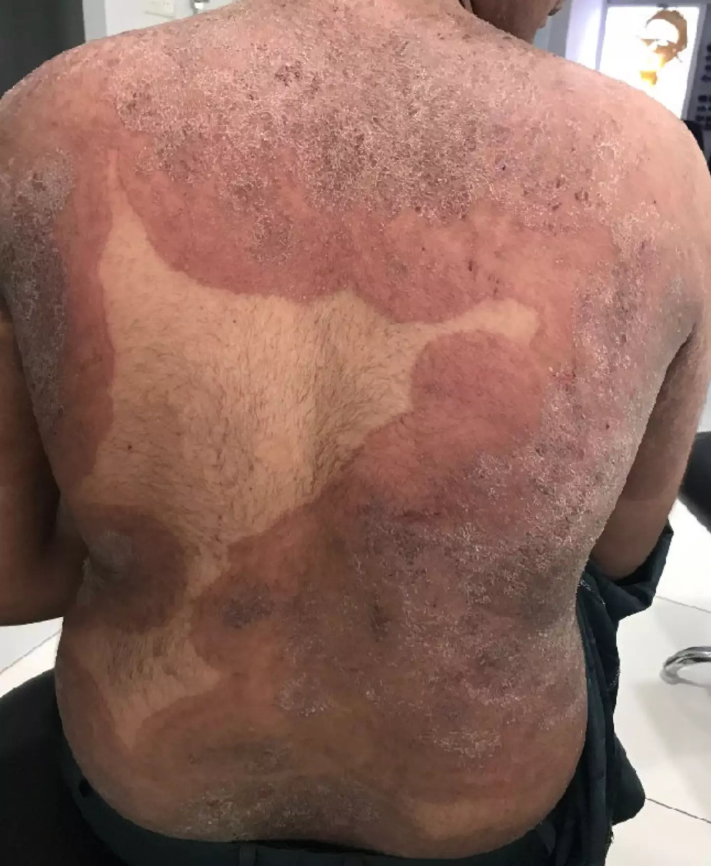 While cases remain low, the condition can spread easily and shouldn't be confused with eczema (MDPI)