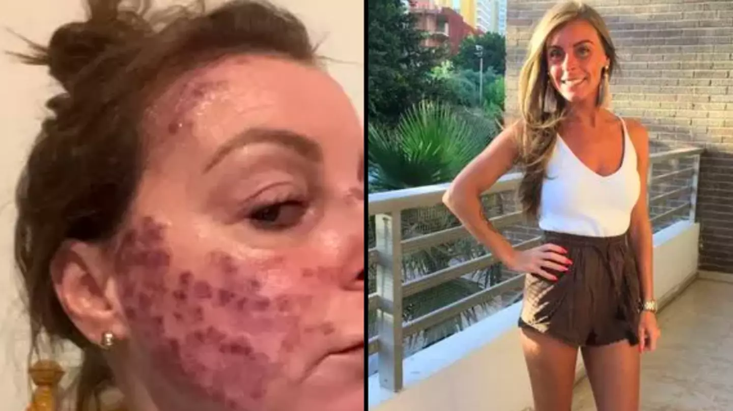 Woman warns ‘a tan is not worth it’ after being left ‘days from death’