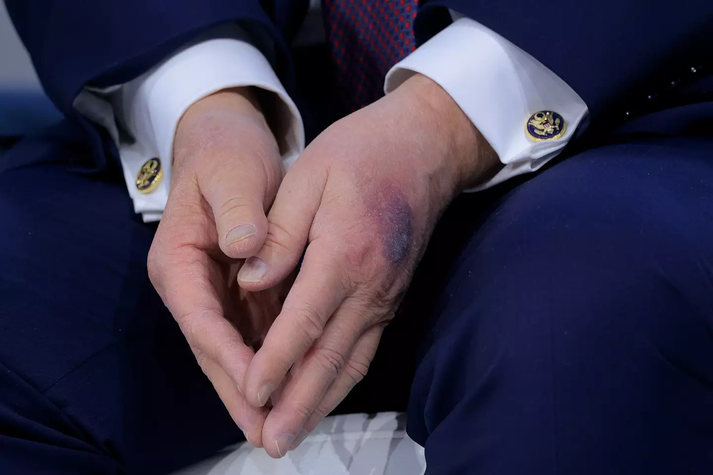 A large bruise has been spotted on Trump's left hand (Chip Somodevilla/Getty Images)