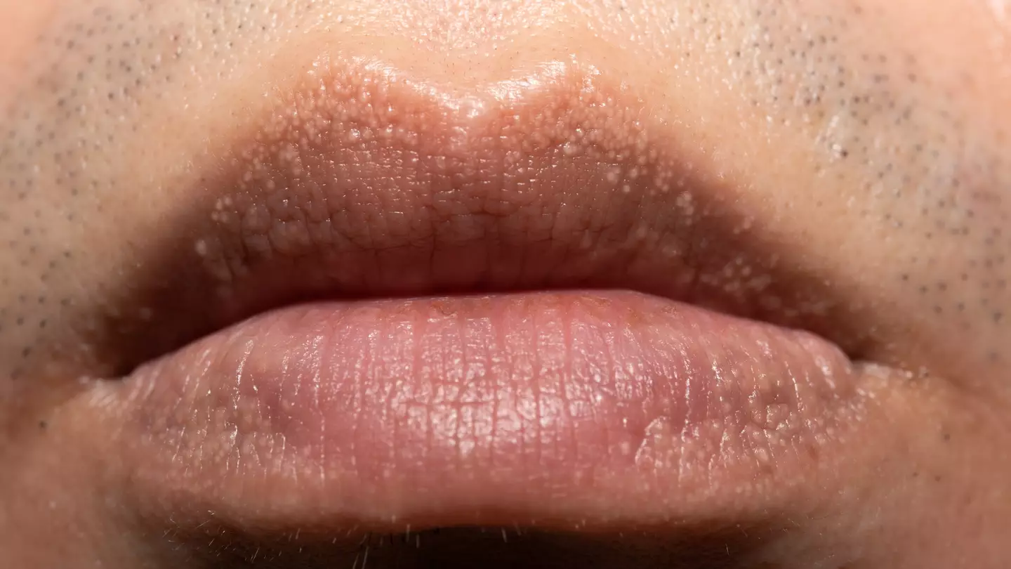 What to do if you spot strange white bumps on body that can also be found on private parts
