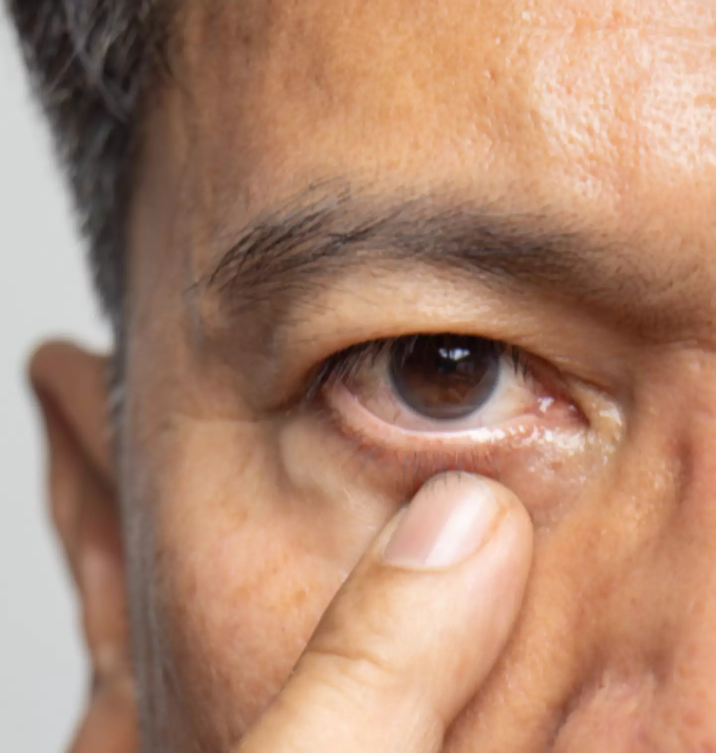 If your eye twitch is severe, it could be early onset Parkinson's Disease.