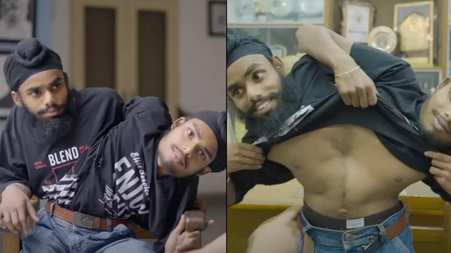 Conjoined twins have two separate identities but are paid just one salary at their job
