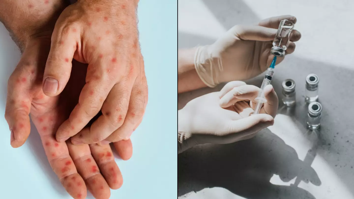 How Britain is preparing for mpox as an expert warns deadly variant of disease has 'very likely' already arrived in UK