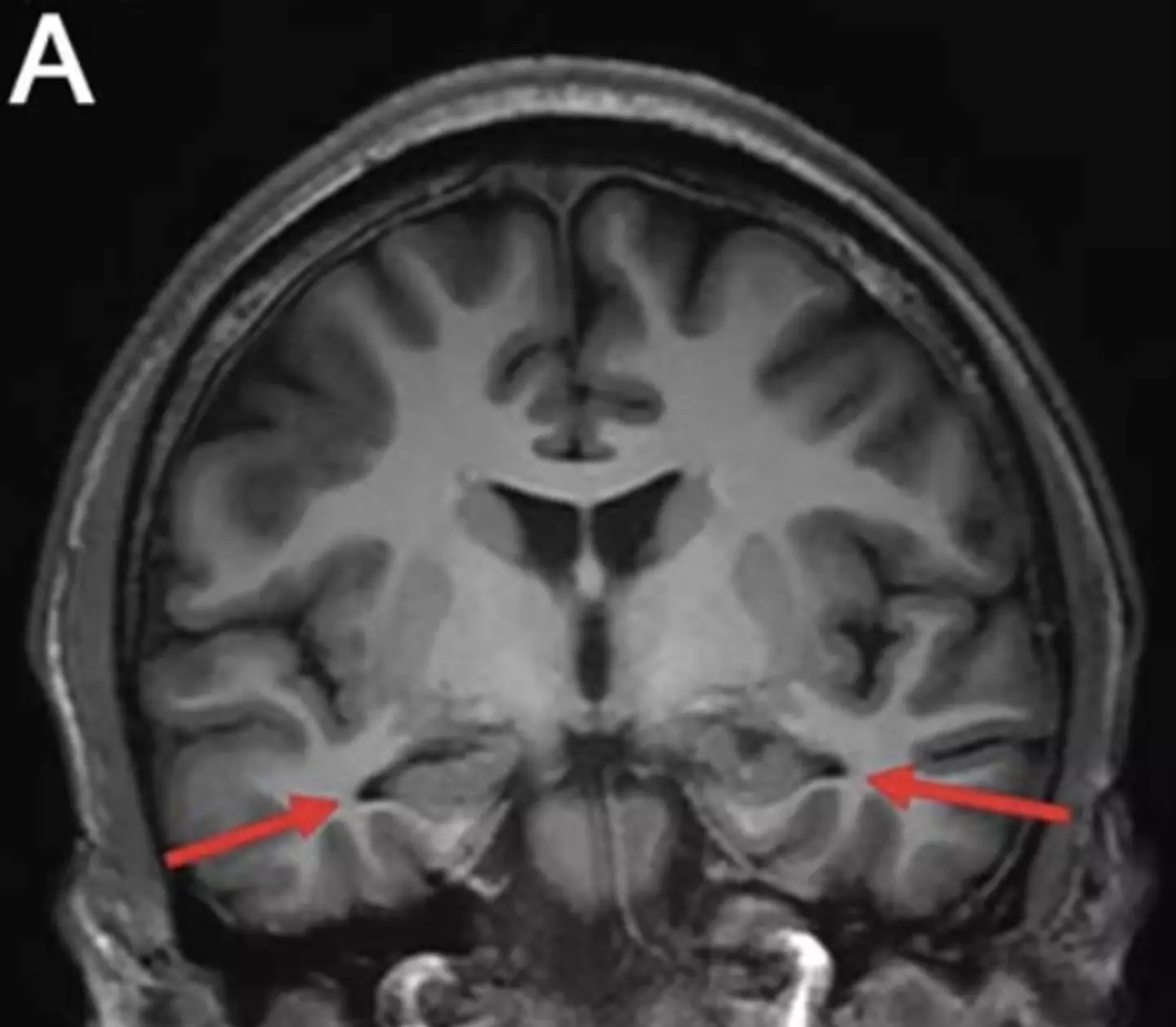 The arrows point out the areas of the 19-year-old's brain which had shrunk due to Alzheimer's (Journal of Alzheimer’s Disease)