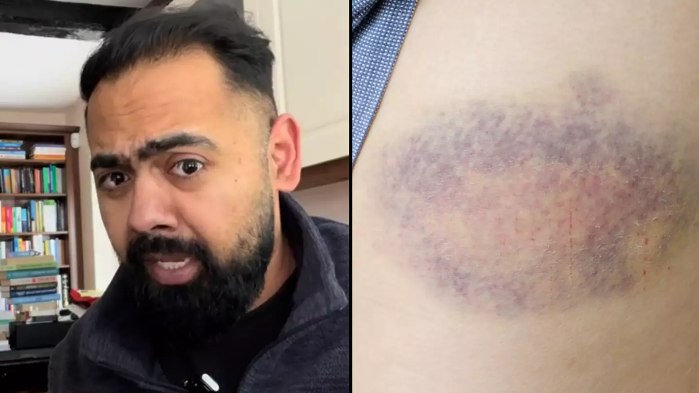 Doctor explains the ‘red flag’ signs that your bruise could be something worse