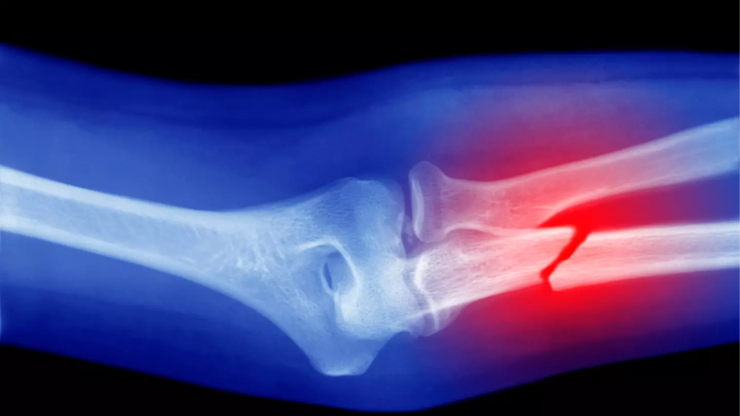 Doctor answers weird theory about people who’ve never broken a bone