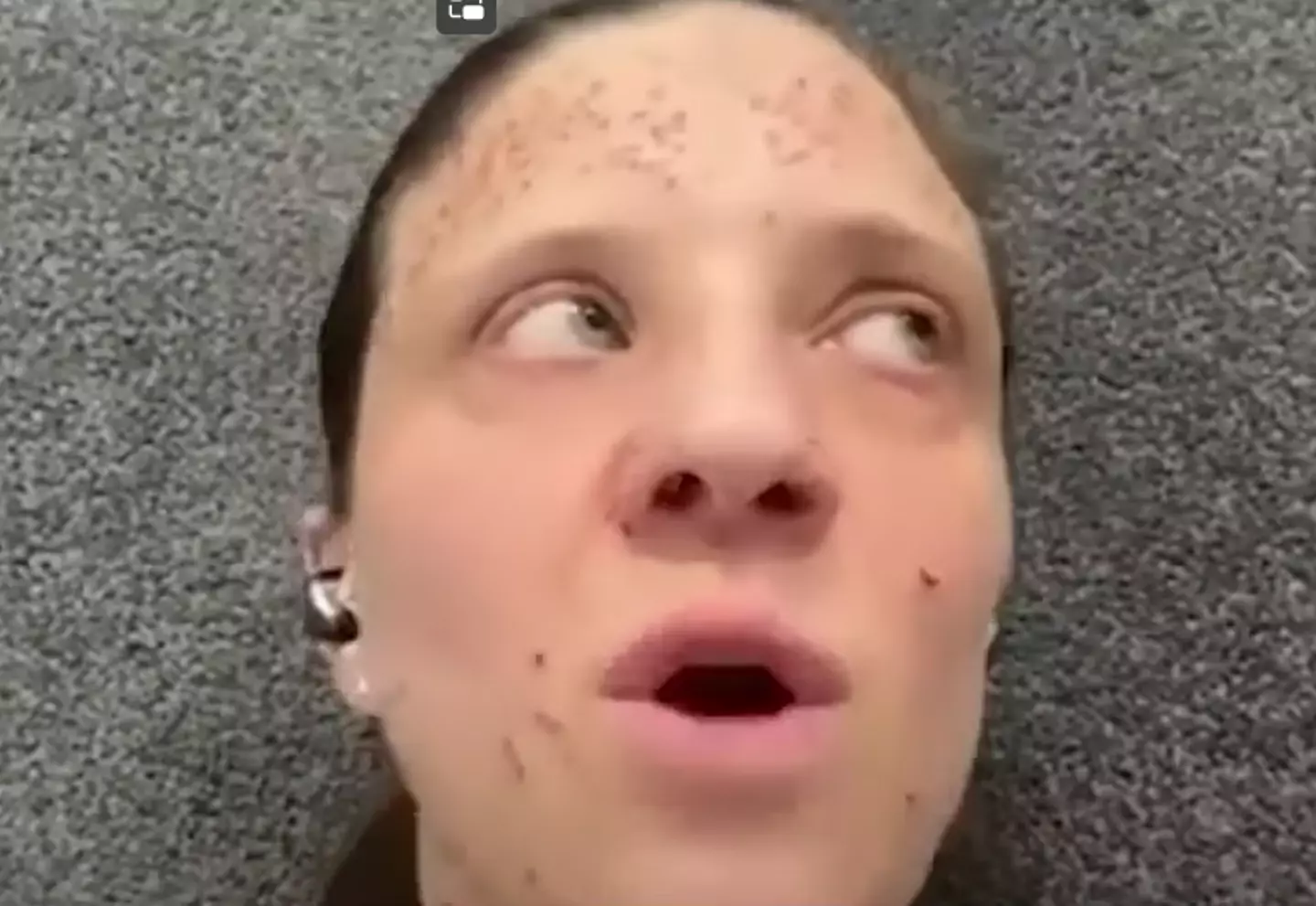 Brianna Solari has a rare skin disorder which causes non-cancerous tumours to grow on her body. (YouTube/ KCRA 3)