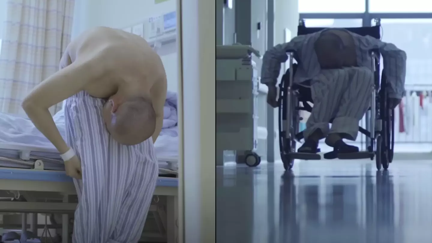 'Folded man' who spent 28 years bent over finally gets surgery to stand up straight