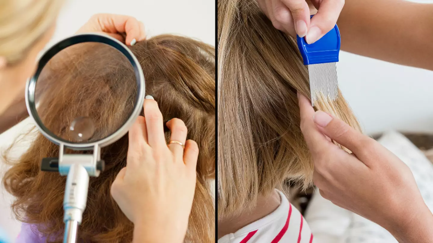 Mum refuses to kill her child’s head lice because she’s vegan and doesn’t want to murder a living thing