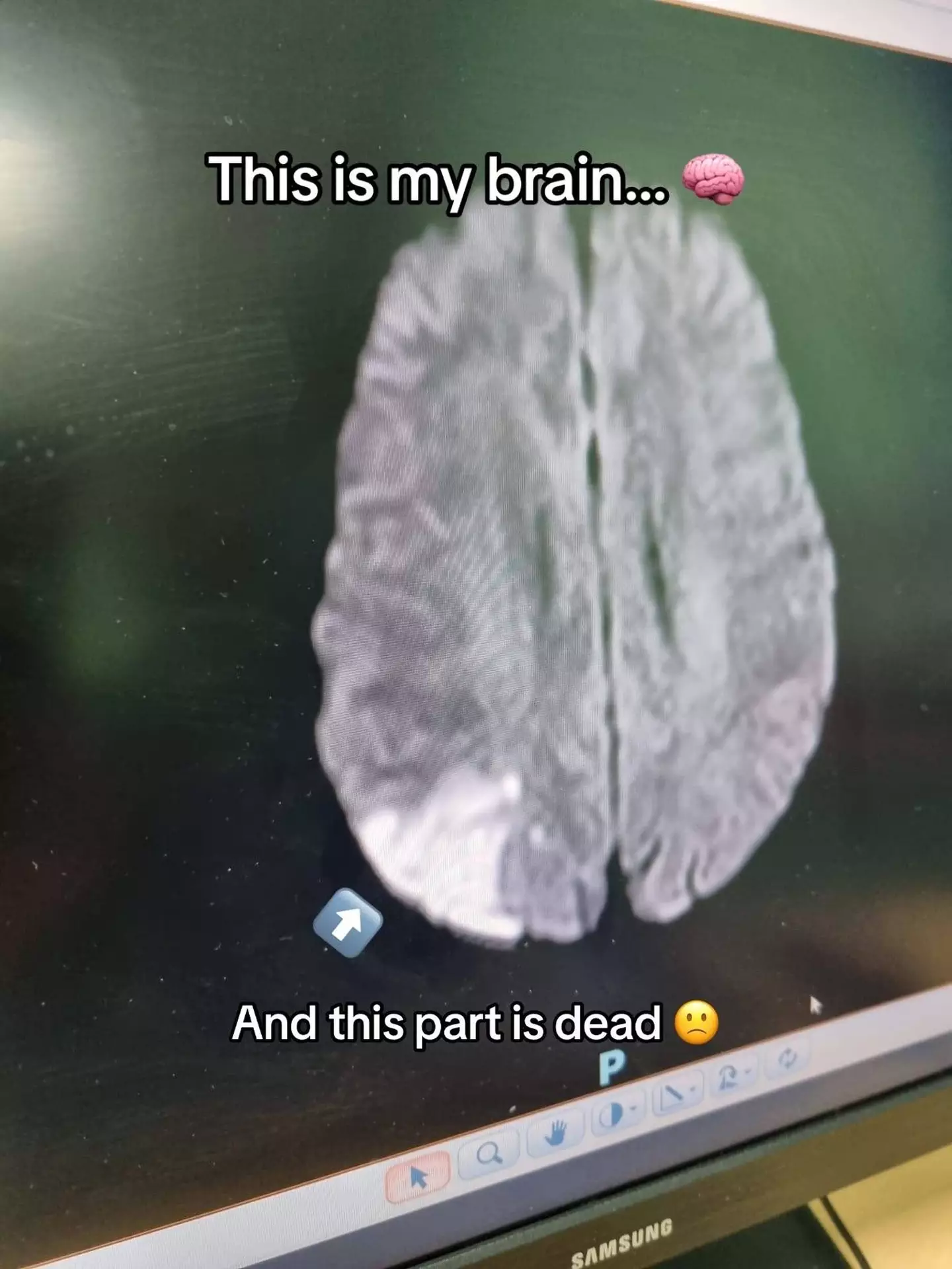 He was told that an eighth of his brain had died after he'd had a stroke.