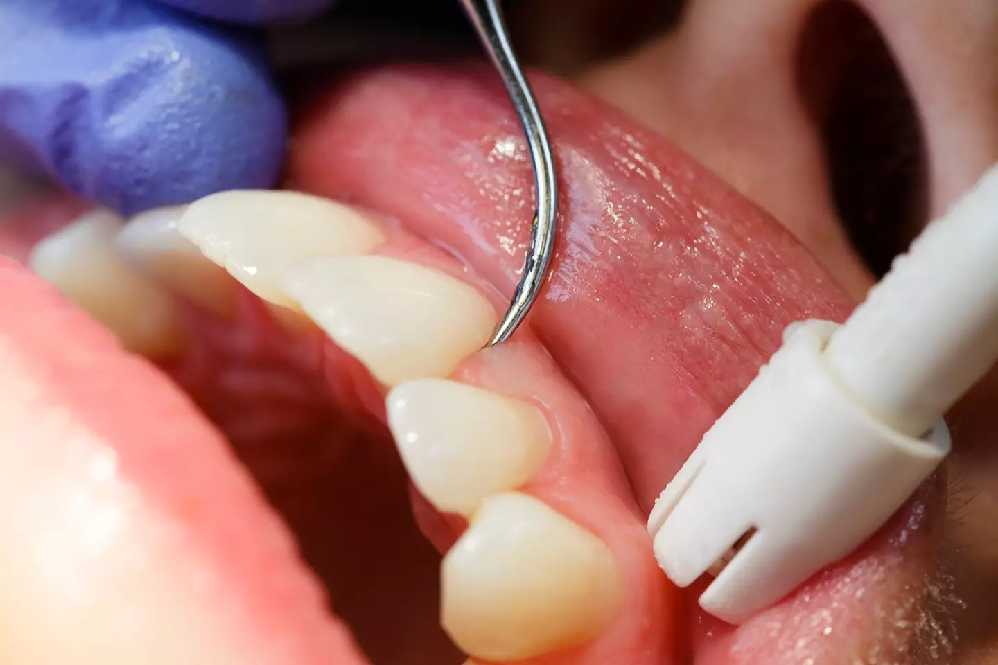Here is another reason not to miss out on your trip to the dentist (Getty Stock Images)