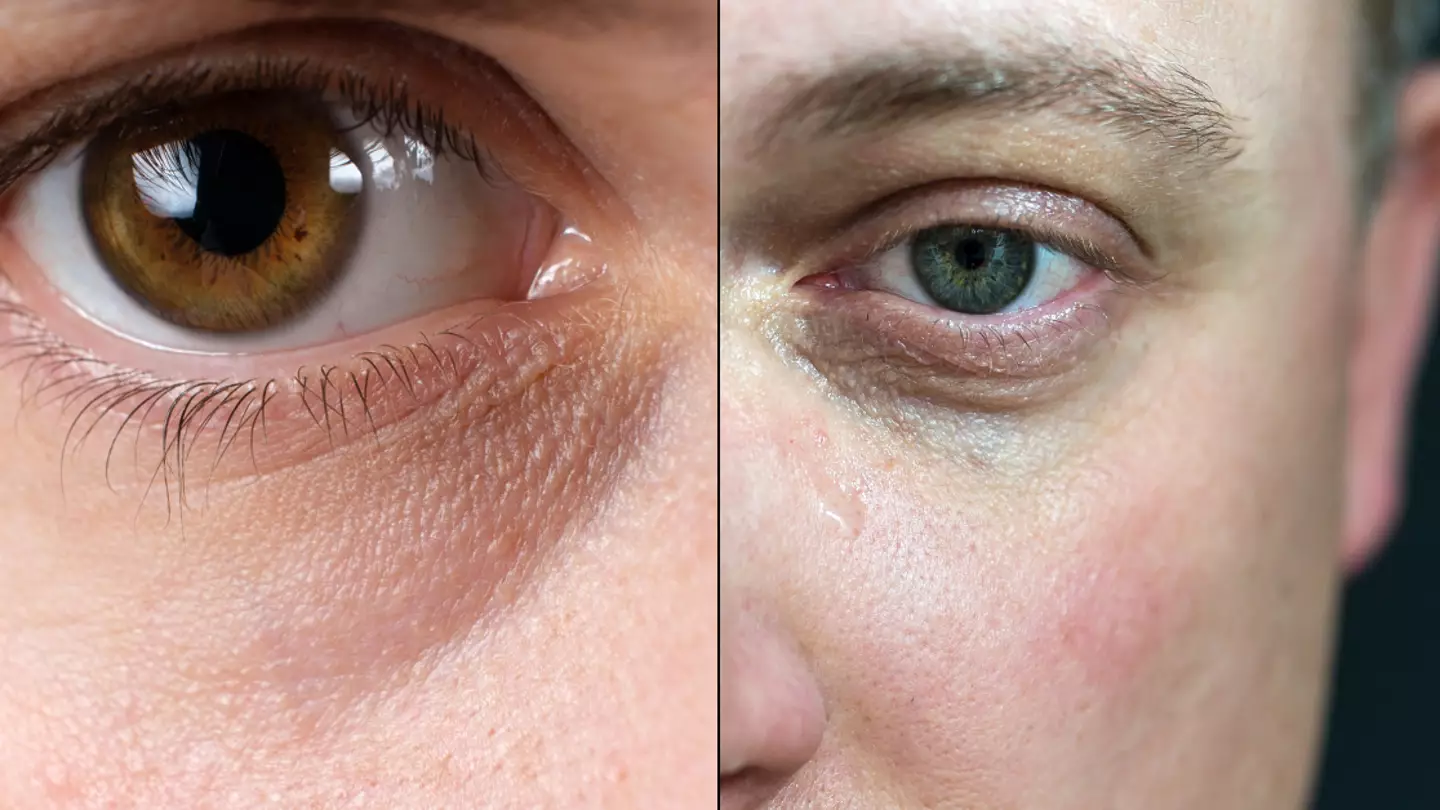 People commonly put dark circles around eyes down to tiredness but it's not the only cause