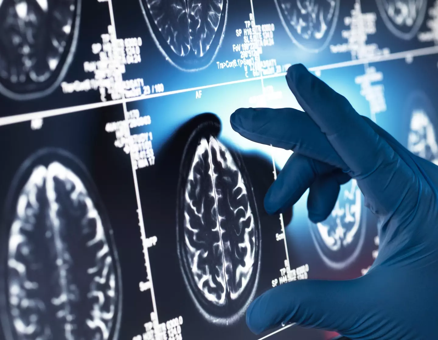 Alzheimer's disease mainly impacts older people (Getty Stock Images)