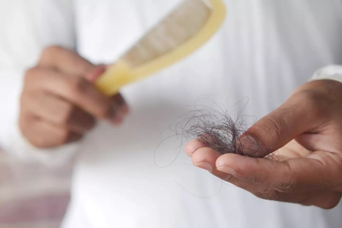 Alopecia Areta is caused by the body attacking its own healthy hair follicles.