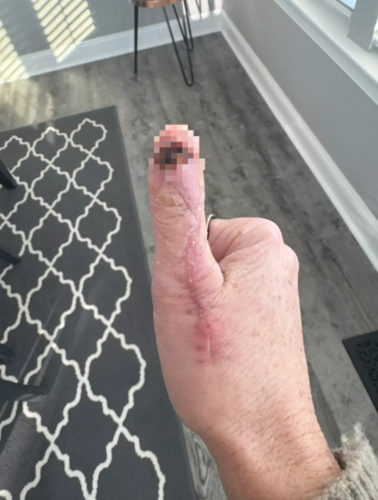 Michelle's post-surgery scar (Kennedy News and Media)