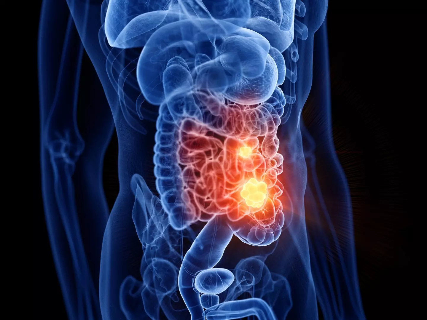 Colorectal cancer is increasing in England's under 50 population (Getty Stock Images)