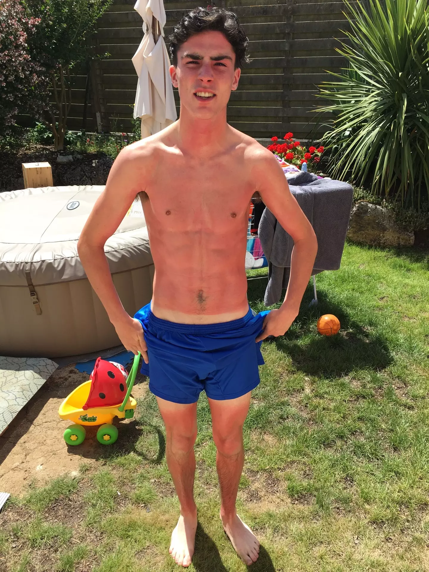 The lad was left with second-degree burns after his sunbathing mishap (Kennedy News and Media)