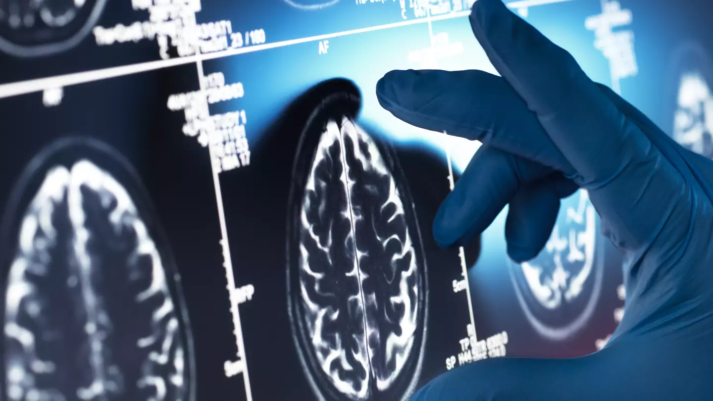 Four early-warning patterns to detect Alzheimer's as disease 'doesn't strike at random'