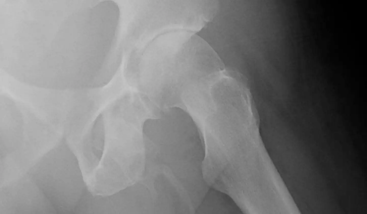 A bone was growing in his penis (Science Direct)