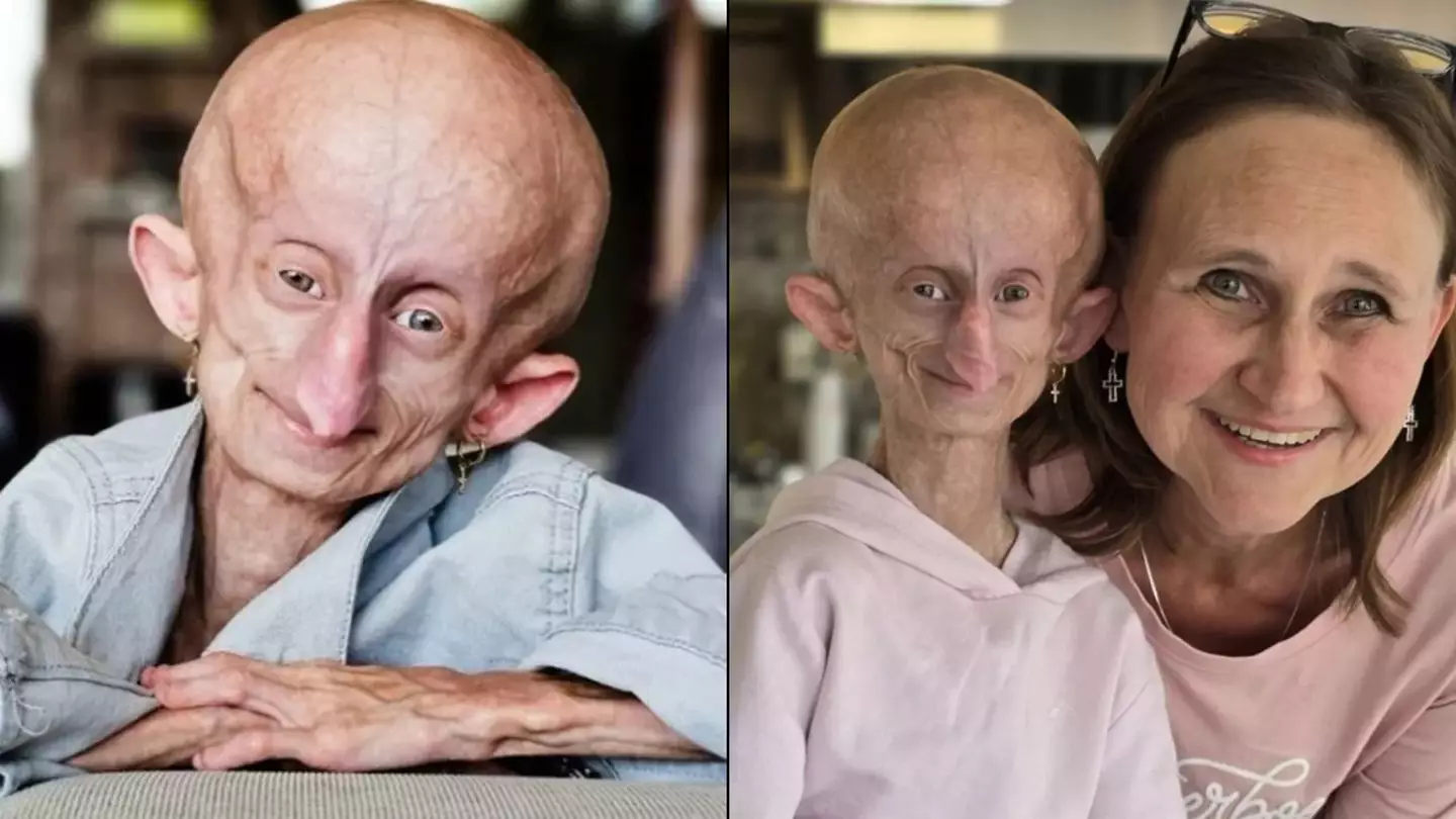 Teenage girl with the bodily age of 152 years old dies aged 19 due to rare condition