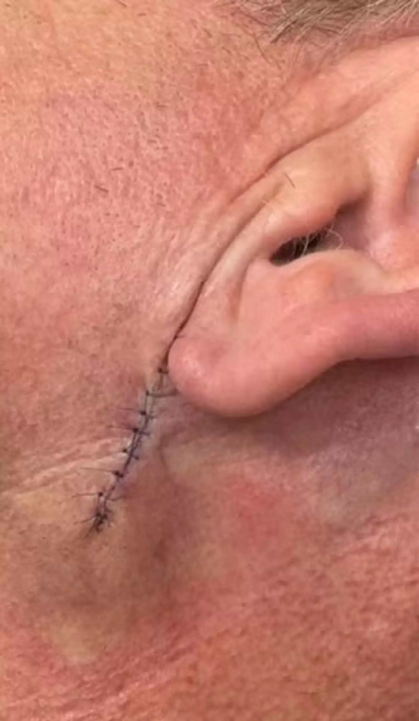 Ramsay said he underwent surgery to remove basal cell carcinoma (Instagram/@gordongram)