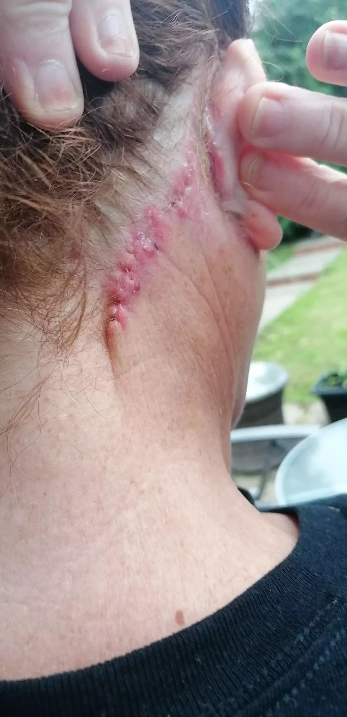 Joanne's scars are still very visible, more than a year after the operation (Kennedy News and Media)